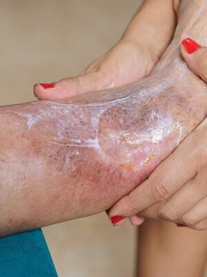 NorCal Wound Care Arterial Ulcer