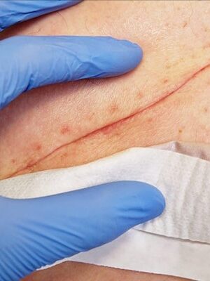NorCal Wound Care Post Surgical Scar