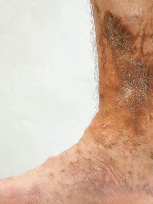 NorCal Wound Care Venous Ulcer